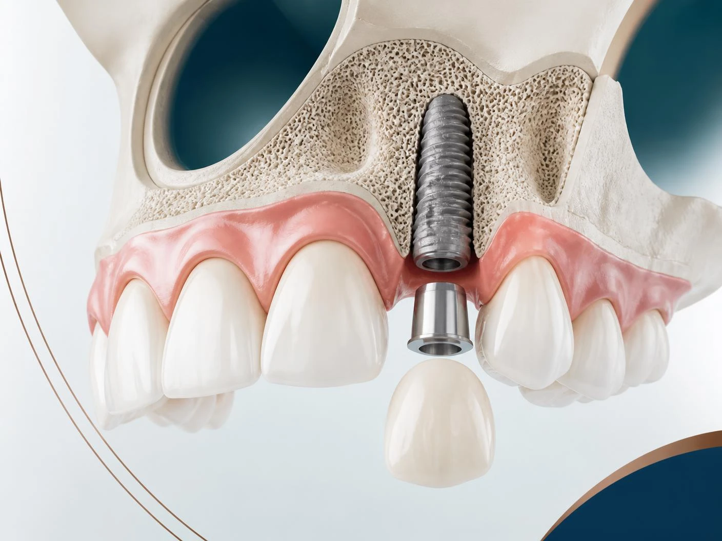 Schéma anatomique d'un implant dentaire posé dans la mâchoire supérieure
